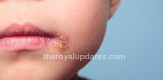 Home Remedies for Impetigo